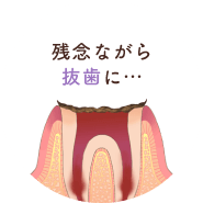 残念ながら抜歯に…