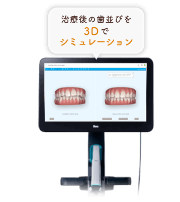 治療後の歯並びを3Dでシミュレーション