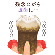 残念ながら抜歯に…
