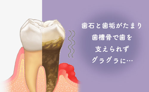 歯石と歯垢がたまり歯槽骨で歯を支えられずグラグラに…